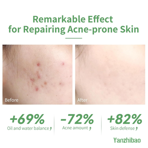 Serum asam salisilat 10%, perawatan jerawat untuk wajah, 15ml/0.5oz, meminimalkan pori-pori, perbaikan kulit aktif - Product Image 5