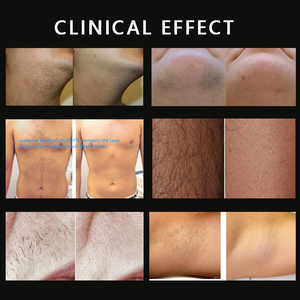 <span class=keywords><strong>Appareil</strong></span> portable d'épilation au laser diode 600W 808nm/755nm/1064nm avec écran tactile couleur 15 pouces et triple système de refroidissement pour - Product Image 6