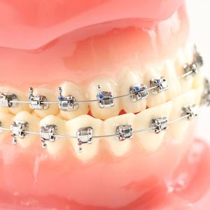 <span class=keywords><strong>Brackets</strong></span> Dentales, Soportes de Ortodoncia Metálicos, Mini Ganchos Roth, 20 Piezas por Paquete, Multiusos - Product Image 3