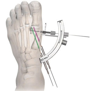 Kit de Instrumentos de Cirugía de Antepié Manual Mínimamente Invasivo de Acero Inoxidable, Implante Ortopédico para Trauma, Placa de Reconstrucción Pélvica - Product Image 1