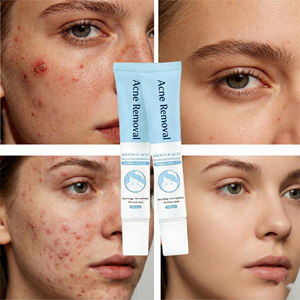 Gel Traitant Anti-Acné à l'Acide Salicylique à Action Rapide – Répare les Cicatrices d'Acné, Estompe les Taches Brunes, Lisse la <span class=keywords><strong>Peau</strong></span> Rugueuse, Minimise les Pores Dilatés - Product Image 1