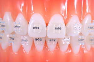 [Worldbiotech] Orthodontic Bracket Self Ligating Bracket Low Friction Bracket <strong>Dental</strong> Adjustment Bracket Orthodontic Lucid - Product Image 3