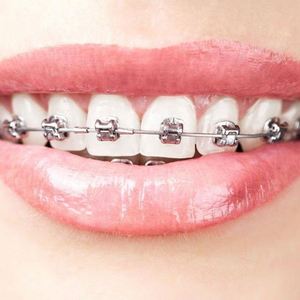 <span class=keywords><strong>Mini</strong></span> staffe in metallo Monoblock ortodontico dentale tutore <span class=keywords><strong>Roth</strong></span>/MBT 022/018 gancio 345 - Product Image 6