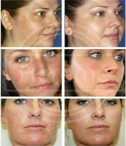 Hot Anti-wrinkle Meso Liquid Solution Hyaluronic acid VB12 VC HA Mesotherapy injection