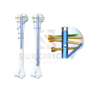 Implante Ortopédico Médico Profesional de Acero Inoxidable, Clavo Interlocking Multiloc Humeral, Manual, Certificado CE por Surgiright - Product Image 4