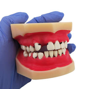 Modelo Educativo de Enseñanza Dental, Modelo de Enfermedad Periodontal - Product Image 3