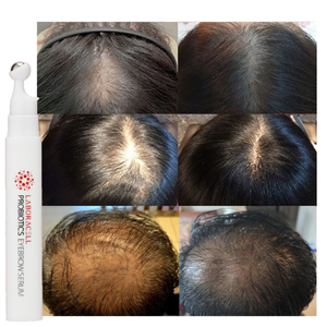 เซรั่มปลูกผมและบำรุงหนังศีรษะแบบโรลออนจากเกาหลี 100% ธรรมชาติ ป้องกันผมร่วง บำรุงรากผม ช่วยให้ผมแข็งแรงและงอกใหม่ - Product Image 2