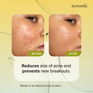 Acne Control <b>Serum</b> Salicylic Acid Camellia Glycolic Niacamide B5 <b>Face</b> Anti-Wrinkle Brightening 30ml Home Use Skin - Product Image 6