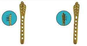 Plaques de verrouillage TPLO 2.0mm 2.4-2.7-3.5mm Set Droite Gauche Vétérinaire Orthopédique 8Pc Ce Approuvé - Product Image 3