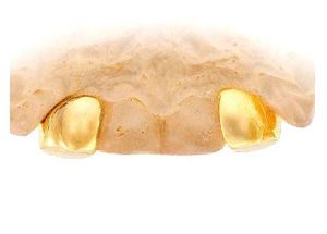 Custom Gold or Silver Grillz-2 Piece Diamond <b>Dust</b> Double <b>Cap</b> Trillion Cut Incisor and Fang-Fine Pendants & Charms - Product Image 3