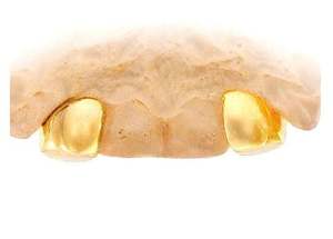 Personnalisé 2X2 Fine Grillz 14K Jaune Blanc Rose Or Incisive Diamant-Poussière Canine Double Caps pour Mariages - Product Image 3