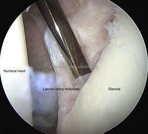 Instrument orthopédique pour la chirurgie d'arthroscopie de l'épaule PRÉPARATION DE JANTE DE DÉBRIMENT GLÉNOÏDE RÂPE RÉPARATION DE BANKART Fourniture de soins de santé - Product Image 5