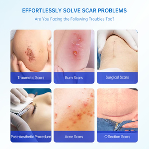 Gel de silicone pour cicatrices sous marque privée, gel cicatrisant OEM, traitement des vergetures, soin des cicatrices d'acné pour peaux sensibles - Product Image 3