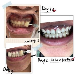 Appareil de blanchiment dentaire à lumière froide LED, haute fréquence, multifonctionnel, traitement de blanchiment des dents, physiothérapie - Product Image 5