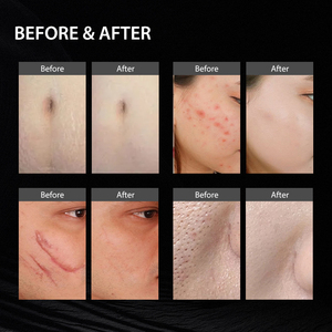 Mesin Fractional Microneedle RF Vakum Terisolasi & Tidak Terisolasi untuk Peremajaan Kulit, Pengencangan Wajah, dan Pengurangan Kerutan dengan Teknologi Thermaging Terbaru - Product Image 6