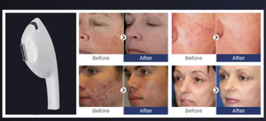 Depiladora Profesional 3 en 1 Multifuncional, Depilación Indolora, Tratamiento para Pecas, Verrugas, Acné y Tatuajes, Superventas - Product Image 5