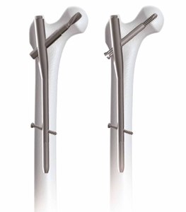 Instrumentos de Cirugía de uñas intramedulares ortopédicos de titanio Base de bloqueo de fémur femoral proximal de herramientas quirúrgicas - Product Image 3