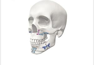 Instrument de chirurgie maxillo-faciale, Instrumentation, noms d'instruments chirurgicaux orthopédiques par Zuol - Product Image 4