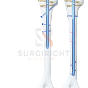 ชุดเครื่องมือผ่าตัดเล็บแบบมีหลายล็อคกระดูกต้นแขนทำจากไทเทเนียมอัลลอย - Product Image 4