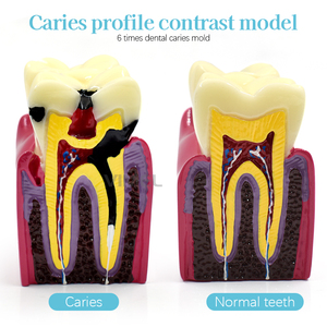 Tandheelkundige Tanden Model 6x Maat Molaire <span class=keywords><strong>Endo</strong></span> Wortelkanaalbehandeling Onderwijs Demo Model Rct Tanden Verval Observatiemodel - Product Image 3