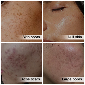 Tumeric đốm đen điểm mực tẩy Corrector salicylic axit mất dần nhược điểm đốm đen loại bỏ mụn trứng cá loại bỏ mực - Product Image 2