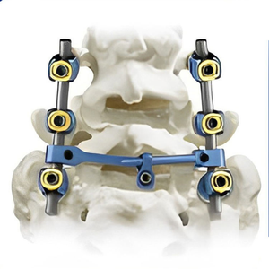 Precio de fábrica 5,5 Juego de instrumentos de tornillo de pedículo espinal Tornillo de pedículo Pakistán Juego de instrumentos de columna vertebral con tornillos de Surgiright - Product Image 1