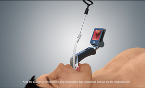 <span class=keywords><strong>Video</strong></span> portabel <span class=keywords><strong>laryngoscope</strong></span> dengan pisau yang dapat digunakan kembali perangkat endoskopi Haiye untuk pasien endotracheal intubation - Product Image 2