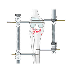 Distractor femoral manual de acero inoxidable más vendido, instrumento quirúrgico médico ortopédico, logotipo y tamaño personalizados - Product Image 1
