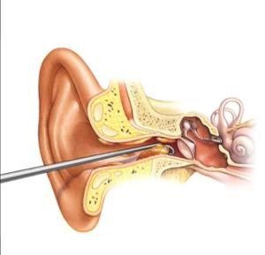Blink Surgident Micro Cerumen en acier inoxydable et Micro Hook Set Instruments chirurgicaux manuels pour oreille médicale - Product Image 4