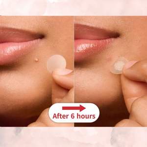 Patch hydrocolloïde coréen OEM ODM pour acné Service personnalisé de marque de distributeur - Product Image 1