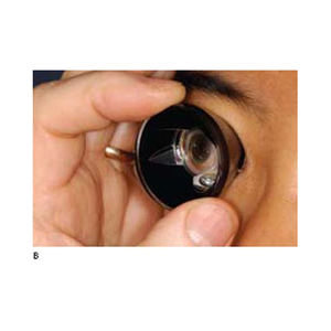 Vente chaude Lentilles Optiques Lentilles Ophtalmiques Trois Goniolens Miroir Au Prix Le Plus Bas - Product Image 5