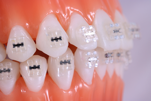 [Worldbiotech] Orthodontic Bracket Self Ligating Bracket Low Friction Bracket <strong>Dental</strong> Adjustment Bracket Orthodontic Lucid - Product Image 2