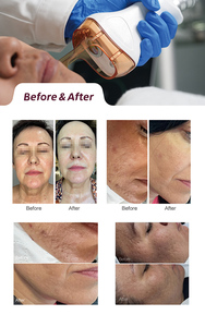 Appareil laser CO2 fractionné CE Medical RF Tube, stationnaire, haute puissance, 10600 nm, pour l'élimination des cicatrices <span class=keywords><strong>d</strong></span>'acné et le resserrement vaginal - Product Image 5