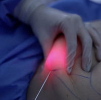 Appareil laser de liposuccion endoliftant GIGAA à double longueur d'onde 1470 nm 980 nm pour les poches sous les yeux