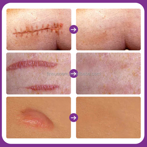 Marque privée Crème réparatrice anti-<span class=keywords><strong>vergeture</strong></span> pour enlever les cicatrices d'acné Crème forte et efficace pour enlever les cicatrices - Product Image 5