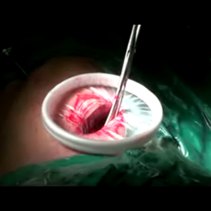 Dùng một lần Alexis owound <span class=keywords><strong>retractor</strong></span> Alexis O vết thương <span class=keywords><strong>retractor</strong></span> với MDR CE giấy chứng nhận - Product Image 6