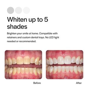 Gel Blanqueador Dental Profesional en Jeringa, Menta, 35% Peróxido de Carbamida, Blanqueamiento Rápido, Baja Sensibilidad, Proveedor Dental OEM ODM - Product Image 3