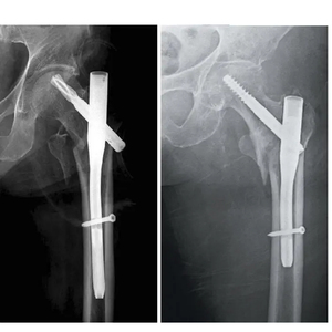 Clous intramédullaires fémoraux, plaque de compression de la scapule, 3,5/4,0 mm, plaque osseuse en acier inoxydable, instruments CE - Product Image 4
