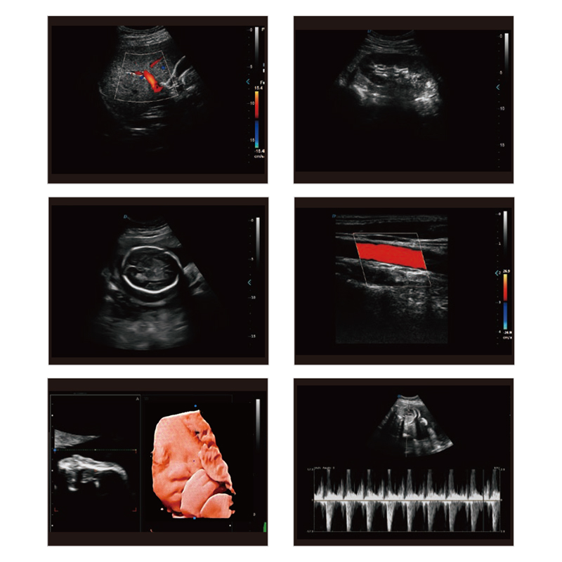 MN-Ultra7A Double Screen Ultrasound Machine Medical Mobile Ultrasound Instruments  Medical Mobile Ultrasound Instruments