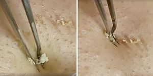 แหนบกำจัดสิวหัวดำและสิวแบบมืออาชีพเครื่องมือดูแลผิวที่ใช้แล้วสำหรับกำจัดสิวสีดำ - Product Image 5