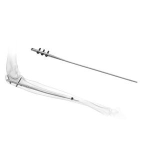 Implante ortopédico de clavo intramedular de cúbito de alta calidad reutilizable de acero inoxidable por REMEDA INSTRUMENT - Product Image 1