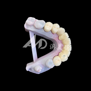 Pont <span class=keywords><strong>dentaire</strong></span> en porcelaine fusionnée au métal (PFM) fiable, couronne pour une restauration <span class=keywords><strong>dentaire</strong></span> fonctionnelle et esthétique - Product Image 6