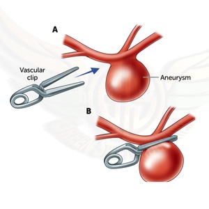 Green swift YASARGIL Aneurysm Clips Stainless Steel Manual CE Certified High Quality Class I Neurosurgery Vascular Instruments - Product Image 4