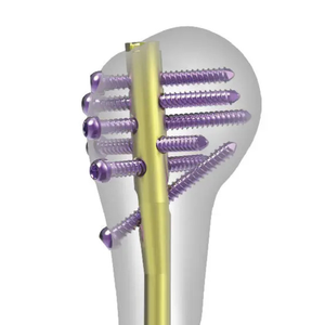 Clou intramédullaire huméral en acier inoxydable, instrument chirurgical orthopédique manuel de haute qualité, certifié CE, réutilisable - Product Image 2