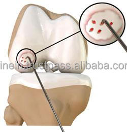 Instrument d'arthroscopie du genou, aiguille à microfracture pour la reconstruction du fémur ACL PCL, réparation en médecine sportive, chirurgie orthopédique médicale - Product Image 5