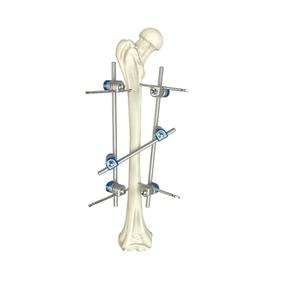 Nuevo Sistema de Fijación Externa de Fémur Médico Profesional de Primera Calidad, Venta Caliente 2025, Juego de Instrumentos Personalizados de 8 mm - Product Image 1