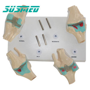 Science médicale anatomie humaine modèle de maladie articulaire modèle de combinaison d'articulation du genou pathologique en 4 étapes - Product Image 4