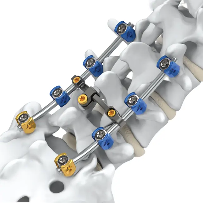 בורג פדיקל הפחתת פולי צירית 5.5 מ""מ קיבוע טיטניום בעמוד השדרה עבור שתלי עמוד שדרה כירורגי אופתופדי עצם