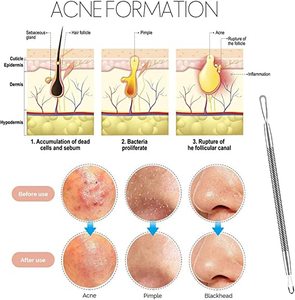 Trending Product Professional Stainless Steel Material Made Pimple <b>Extractor</b> Remover Comedone Spot Acne Pimple Removal Tool - Product Image 2