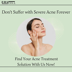 Alta Calidad 30mL Crucell ácido mandélico Peel Etiqueta Privada blanqueamiento de la piel y eliminación de acné resultado químico más rápido de la exfoliación facial - Product Image 6